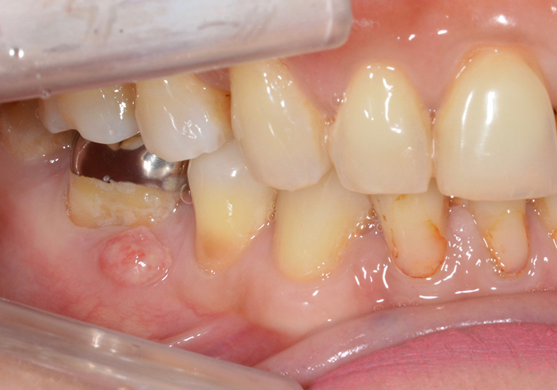 歯の内部の感染が原因で発生した歯肉のできもの