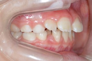 上顎前突(出っ歯)のため、前歯を損傷しやすい
