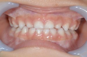 乳歯の切端咬合の写真。自然治癒するかもしれない。