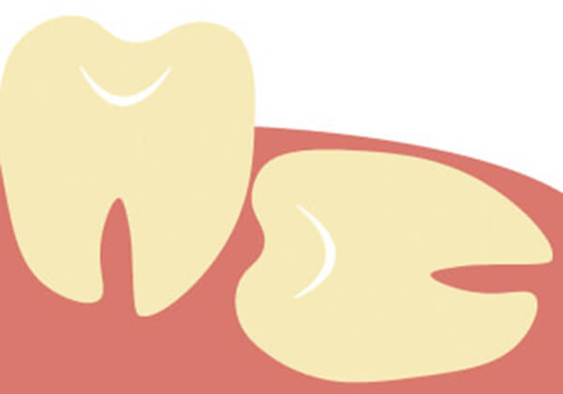 親知らず 藤沢の歯医者 藤沢ギフト歯科 矯正歯科