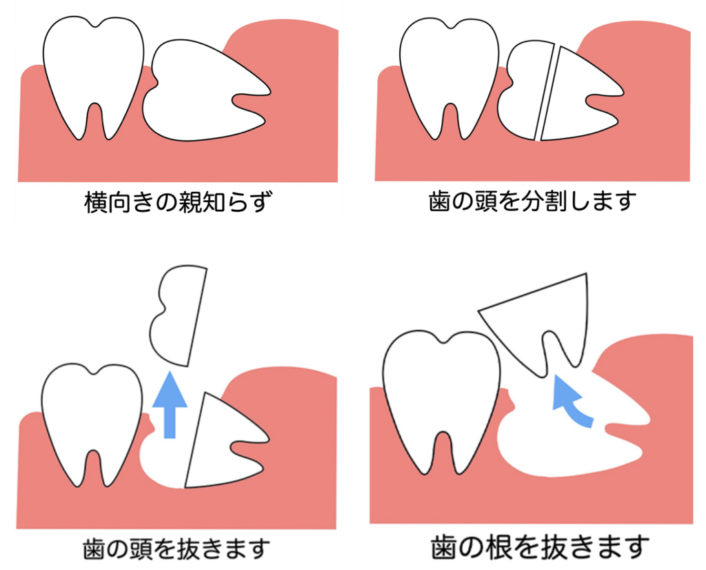 親知らず 抜い た 後