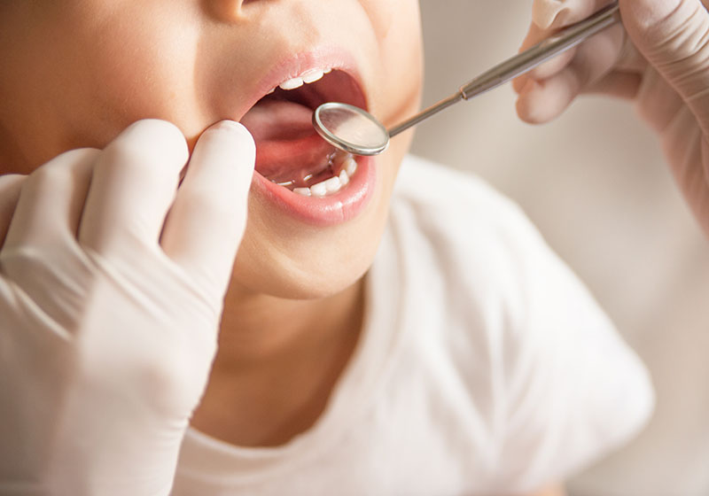 子供の虫歯の原因
